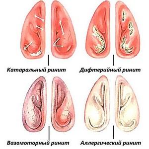 лечить непроходящий насморк