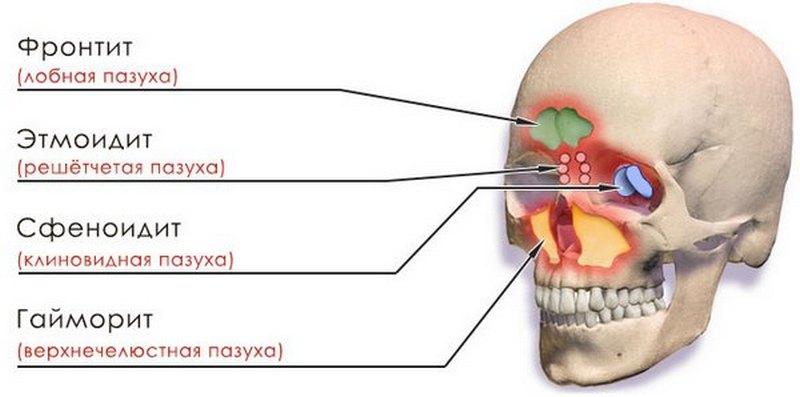 после гайморита насморк не проходит