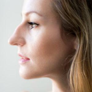 вправить нос самостоятельно