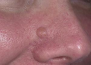 базалиома носа лечение