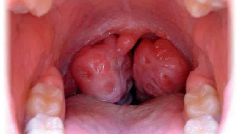 Как лечить красное горло у ребенка