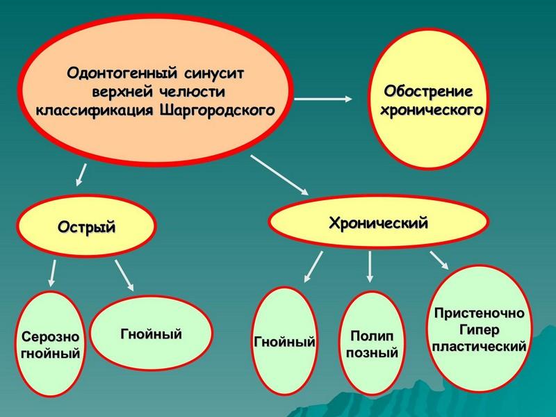 одонтогенный верхнечелюстной синусит