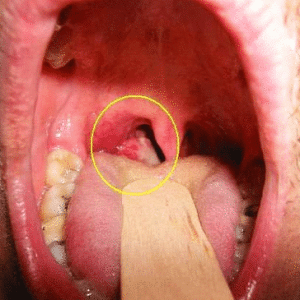 как лечить постоянный кашель
