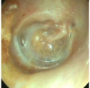 осложнения отита у взрослых