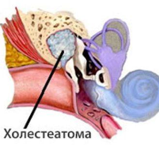 осложнения отита у детей