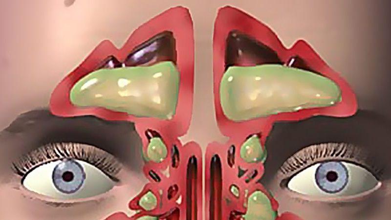 что это такое острый фронтит