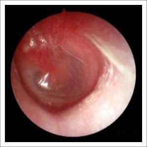 -чем и как лечить грибковый гайморит