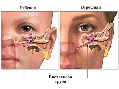 shurshit-v-ukhe-chto-eto