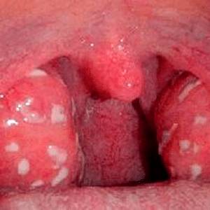 Чем отличается ангина от дифтерии