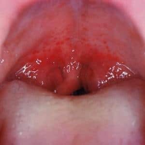 Чем отличается ангина от дифтерии