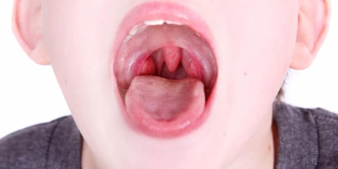 чем ларингит отличается от фарингита