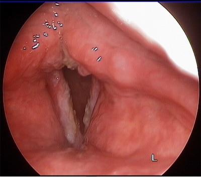 антибиотики при ларингите и фарингите