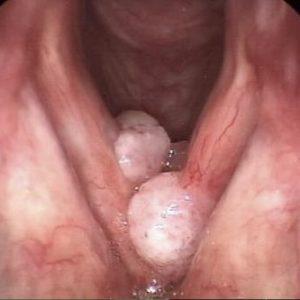 Что делать, если в горле шишки