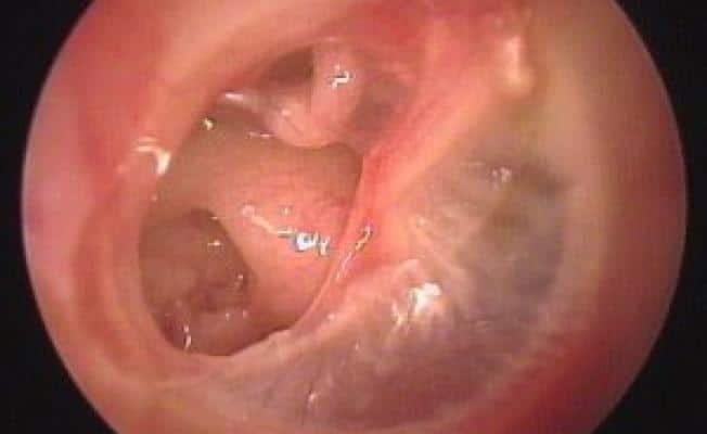 -проткнул ухо ватной палочкой