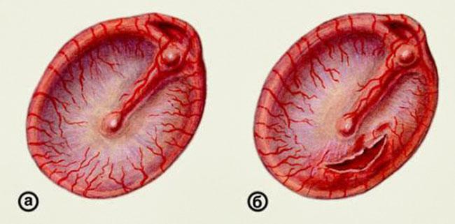 -лопнула перепонка в ухе последствия