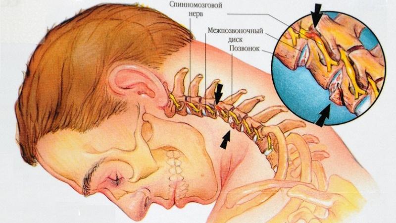 боль в ушах при остеохондрозе