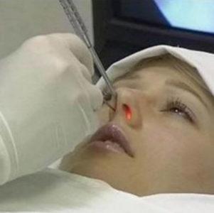 удаление полипов в гайморовых пазухах