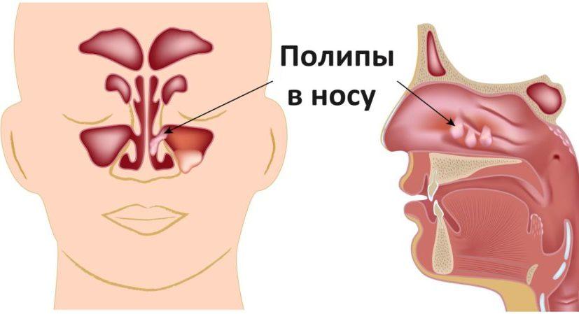 полип в гайморовой пазухе лечение