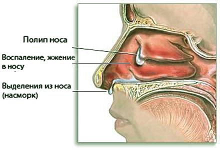 лекарство от полипов в носу