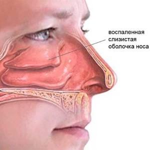 -симптомы и лечение грибкового гайморита