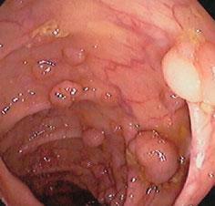 рецидивирующего полипоза носа и околоносовых пазух