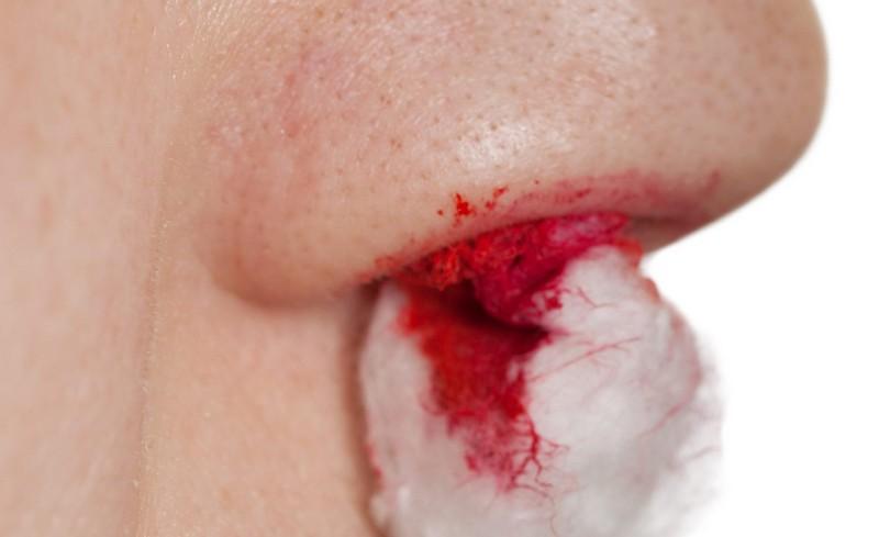 прижигание слизистой носа