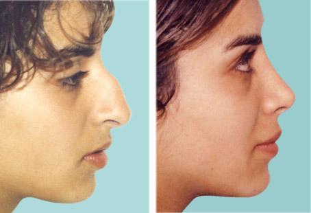 определить сломан ли нос