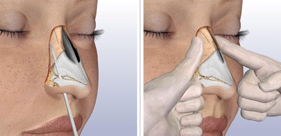 как лечить сломанный нос