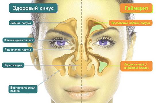 как делают прокол при гайморите фото