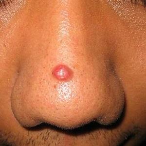 чешется вокруг носа