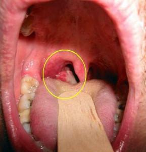 признаки опухоли гортани