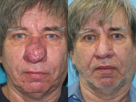 Что делать когда нос покраснел или посинел?