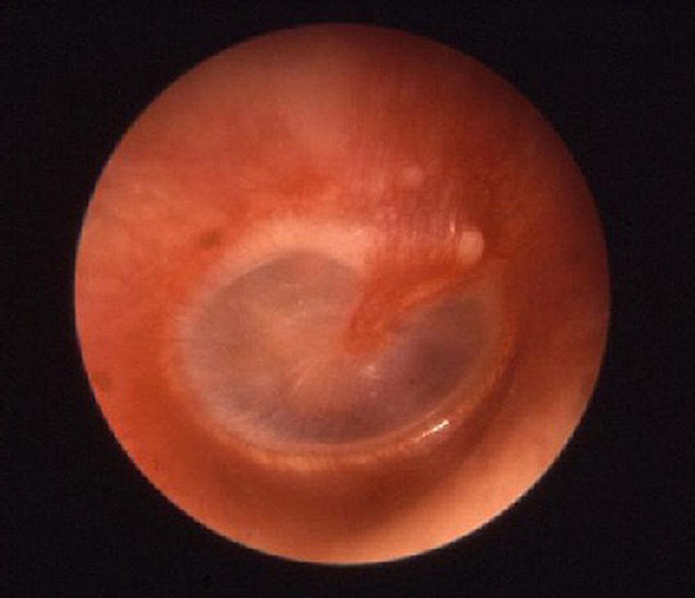 Серозный отит уха