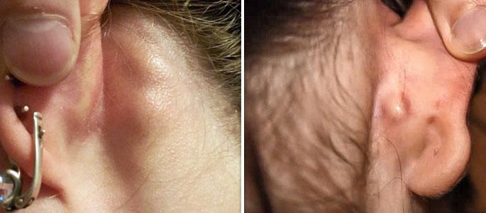 -уплотнение в ухе