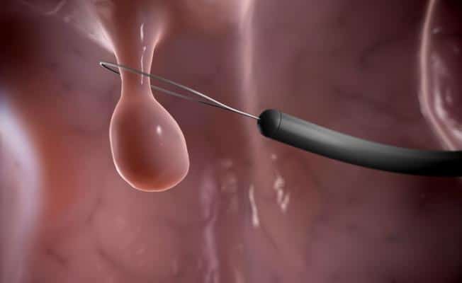 полипоза носа