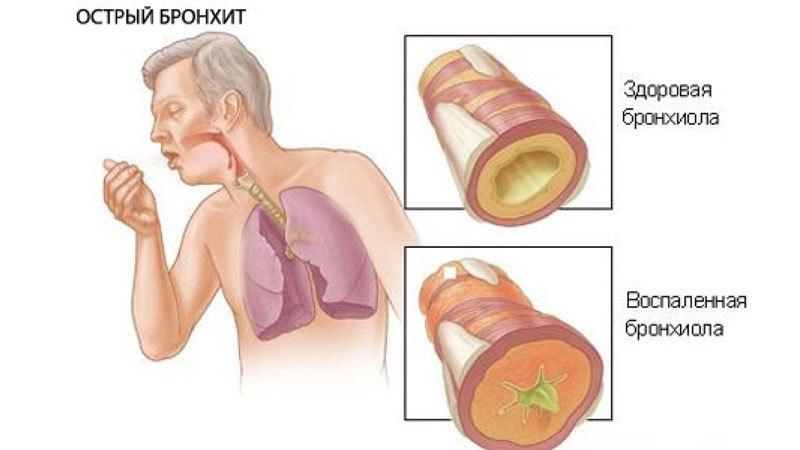 чем лечить кашель без температуры у взрослого
