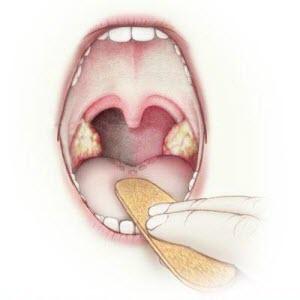 Как лечить ангину без температуры