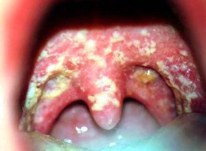 Как лечить ангину без температуры