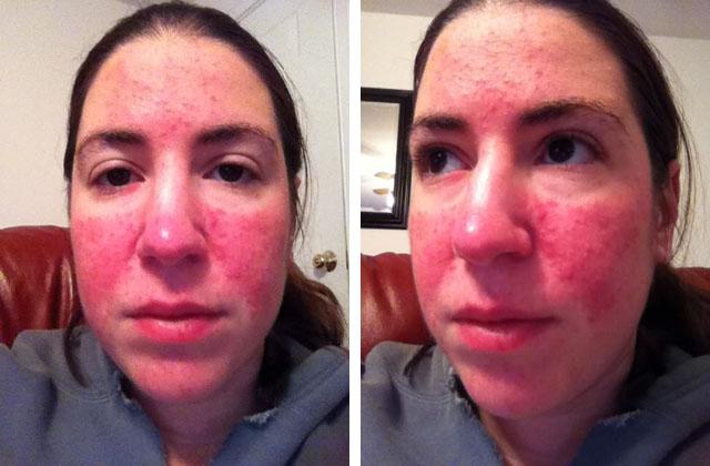 Что делать когда нос покраснел или посинел?