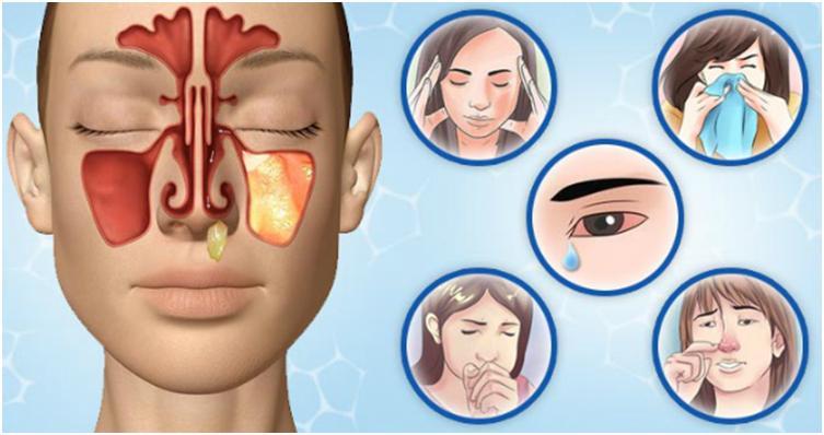 Какие симптомы при гайморите: первые признаки развития болезни