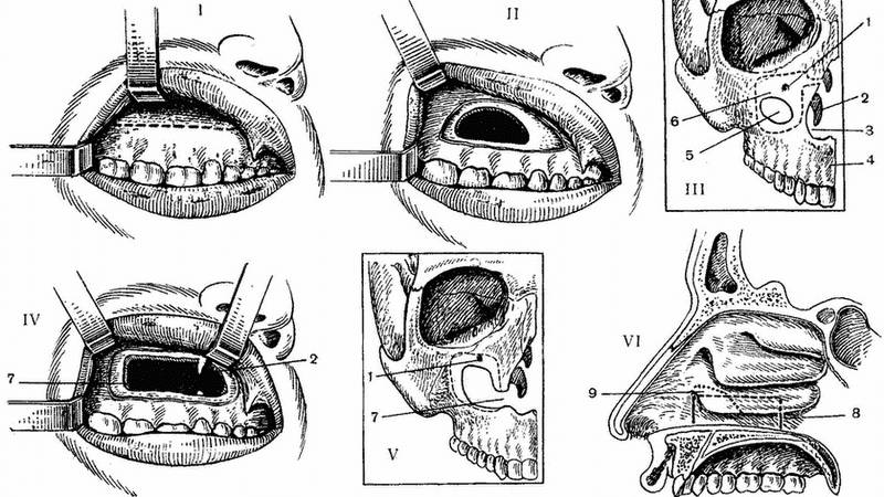 симптомы и лечение кисты в носу