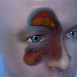 удаление кисты из пазухи носа