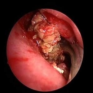 -противогрибковые препараты при гайморите