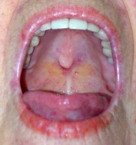 опухоль гортани лечение