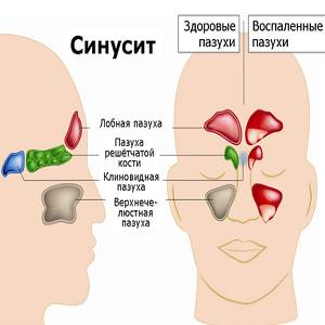 как и чем лечить острый синусит у взрослых