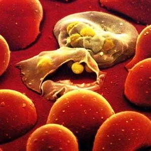 осложнения при синусите