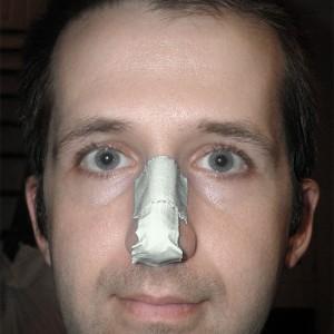 вправить нос самостоятельно