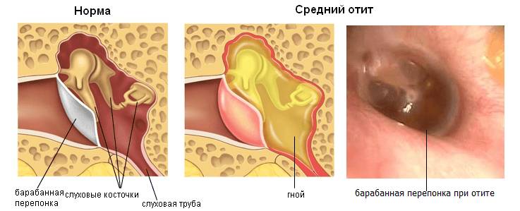 kozelka-vospaleniye-ukha-lecheniye
