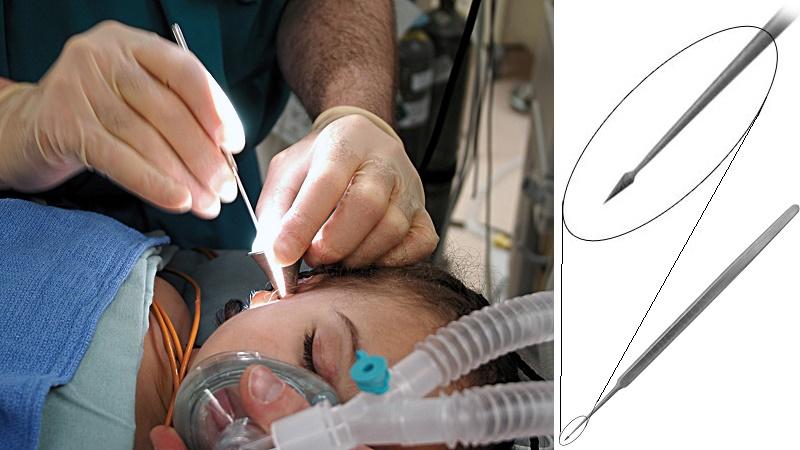 отит операция