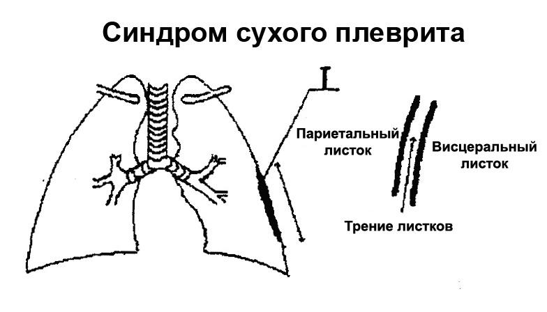 sukhoy-plevrit-simptomy